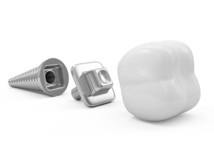 history-of-dental-implants