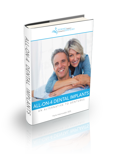 All-on-4-Dental-Implants-Guide-Graphic