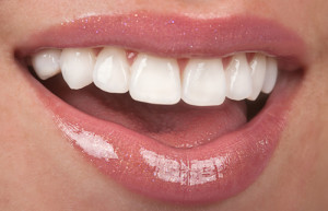 veneers