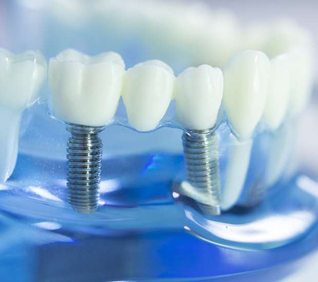 Downey Dental Implants