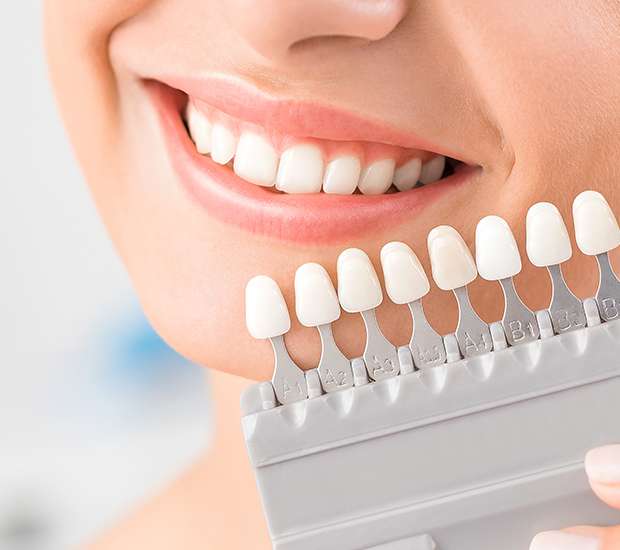 Downey Dental Veneers and Dental Laminates