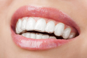 Woman-Wearing-Invisalign-Orthodontics