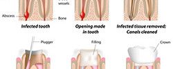 Root Canal Treatment